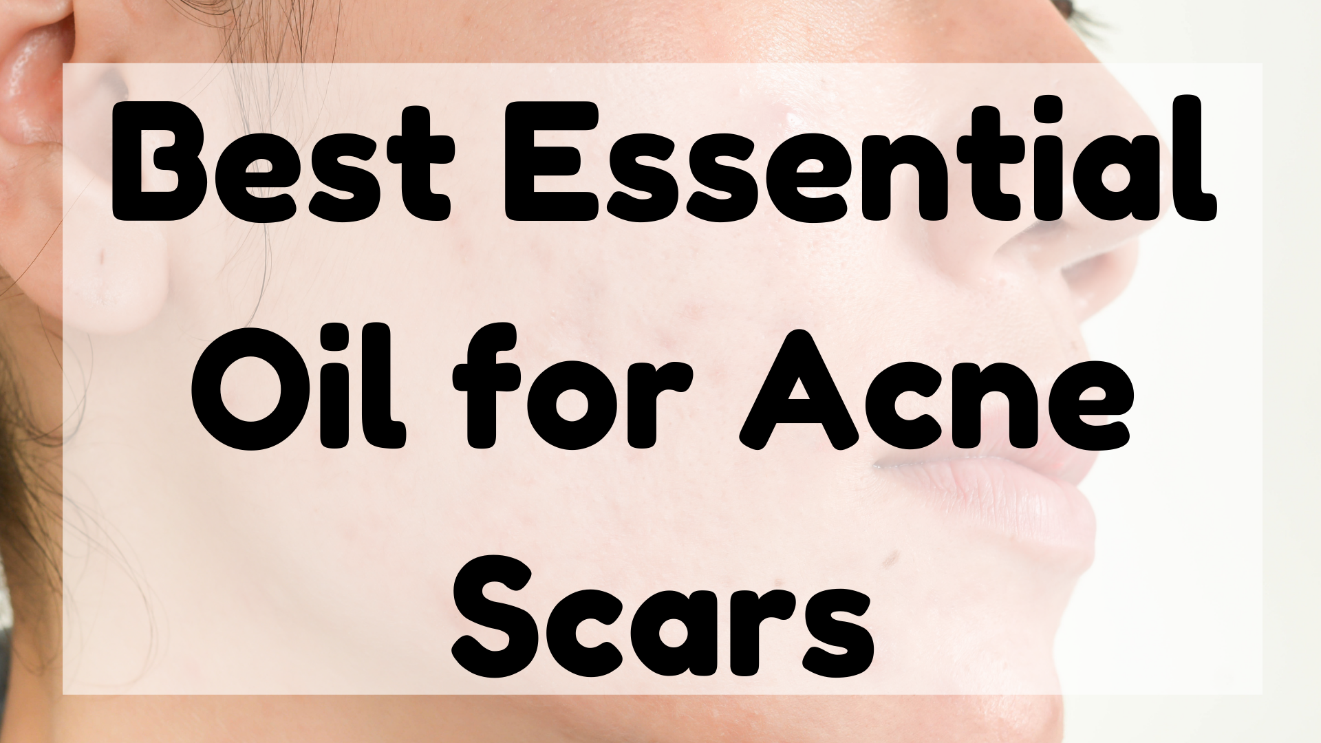 Essential Oil For Acne Scars