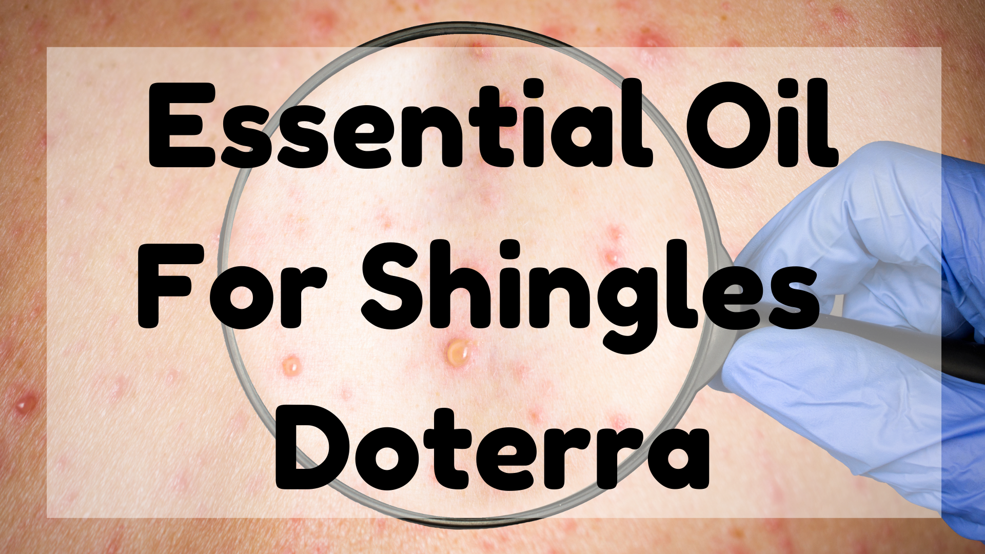 Essential Oil For Shingles - Doterra