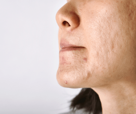acne scars on face