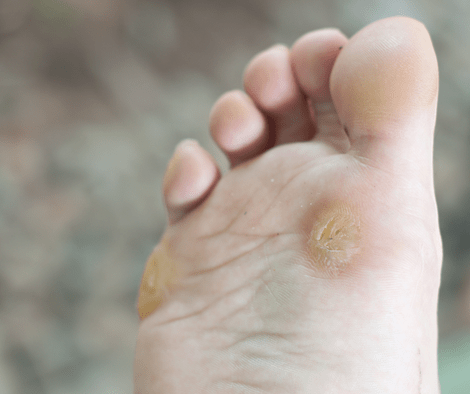 foot with wart (essential oil for planter wart)