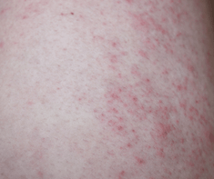 heat rash on skin 
