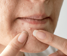 woman with cystic acne