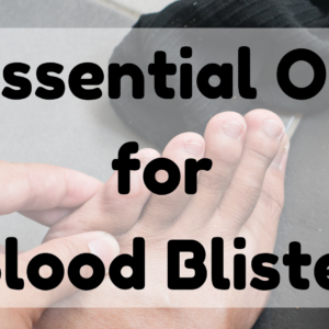 Essential Oil For Blood Blister