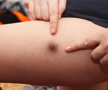 bruised leg (essential oil for hematoma)