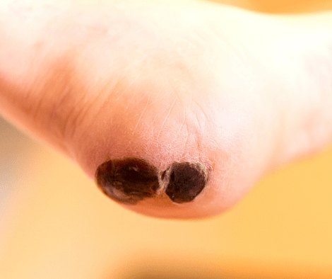 foot with blood blister 