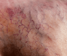 broken capillaries on skin (Essential Oil For Broken Capillaries)