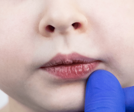 child with chapped lips (Essential Oil For Chapped Lips)