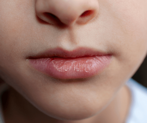closeup photo of chapped lips (Essential Oil For Chapped Lips)