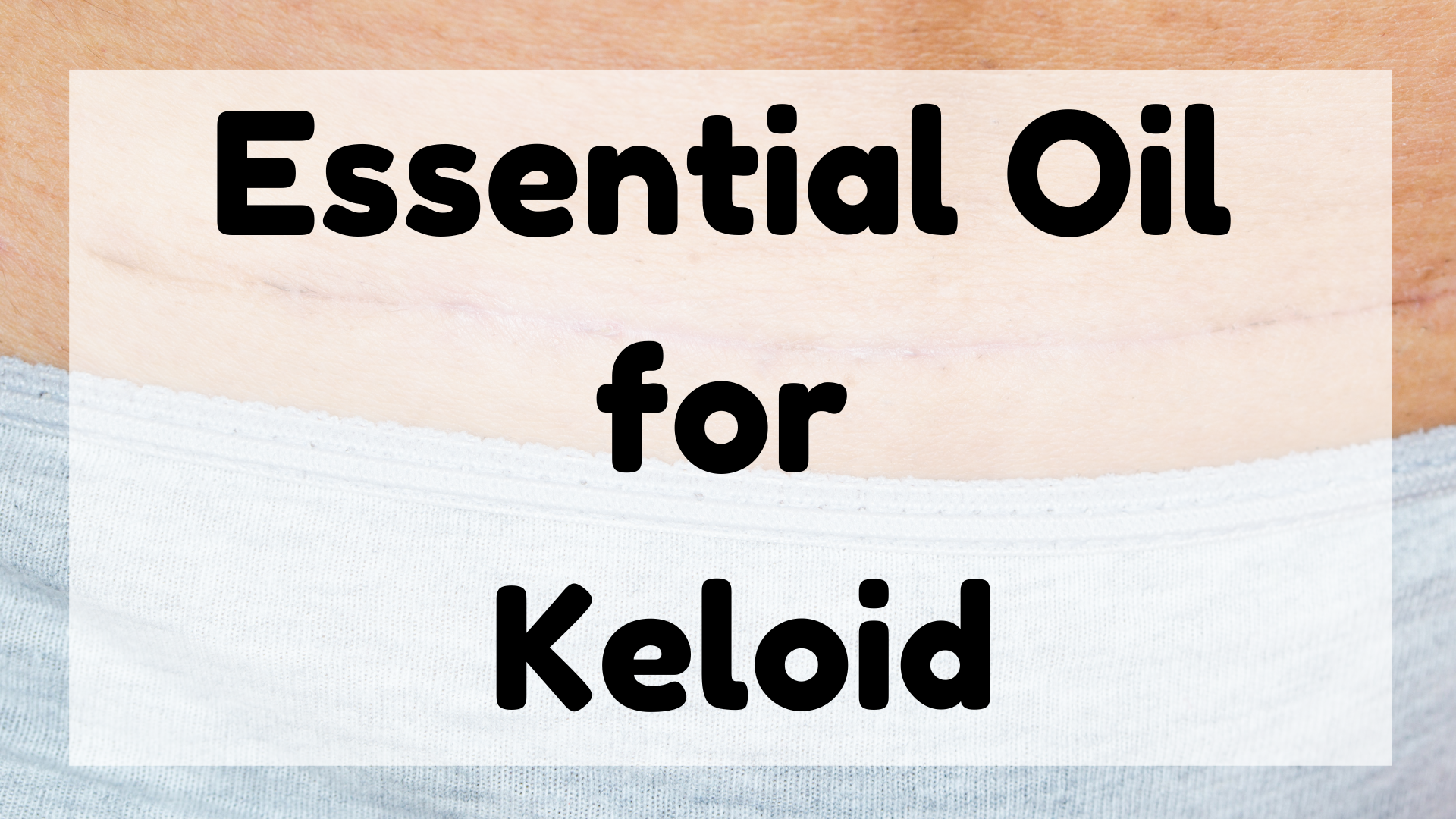 Essential Oil for Keloid featured image