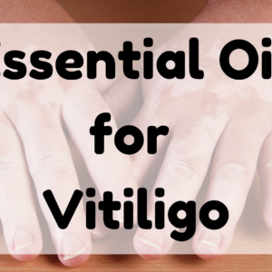 Essential Oil for Vitiligo featured image