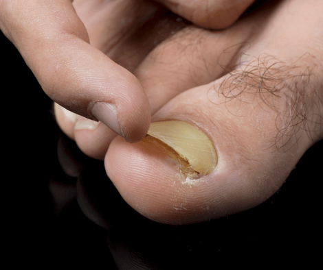 closeup photo of toenail fungus