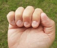 hand with ingrown fingernails