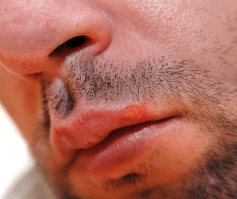 man with fever blister mouth