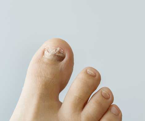 nail fungus on right foot
