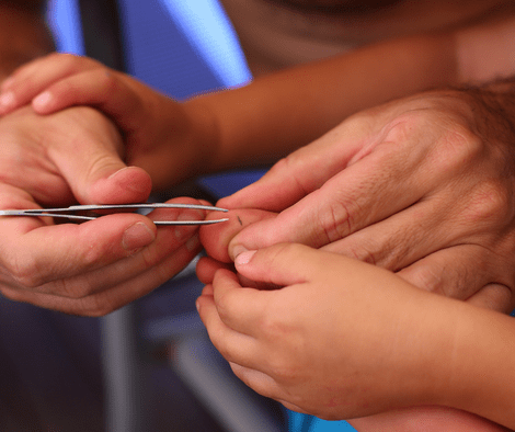 removing splinter from finger