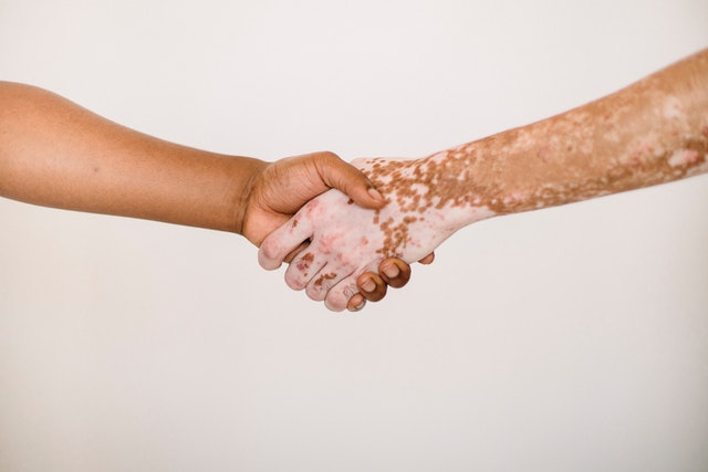 two hands with vitiligo
