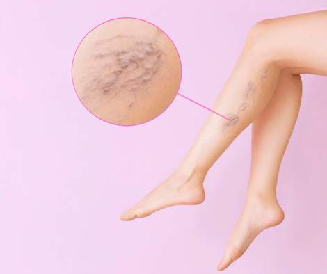 varicose veins on left leg