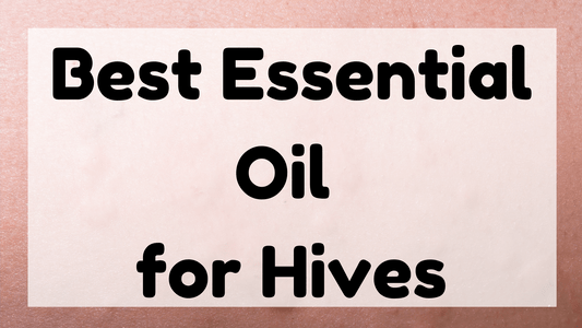 Best Essential Oil for Hives featured image