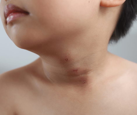 child with chigger bites