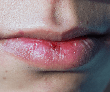closeup photo of dry mouth