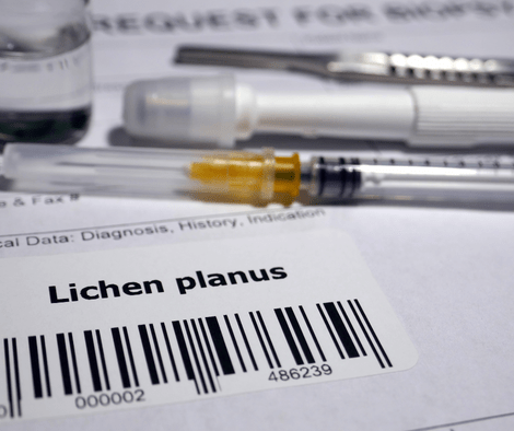 diagnosing lichen planus