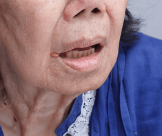 old woman with Angular Cheilitis