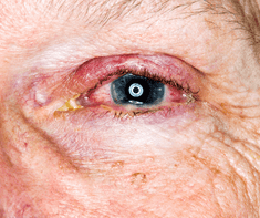 old woman with eye infection