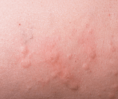 skin with hives 
