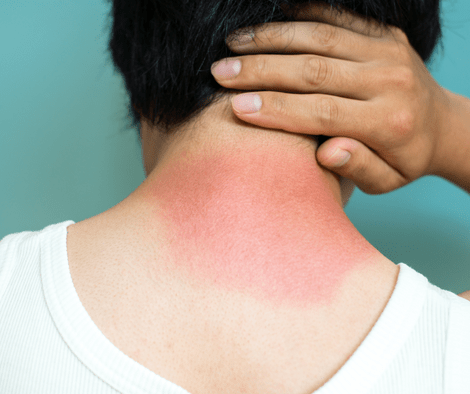 sunburn on neck