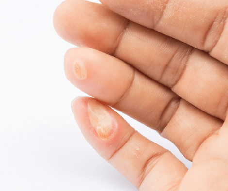 warts on fingers treatment