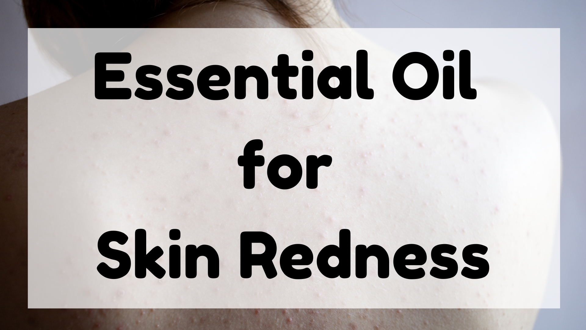 Essential Oil for Skin Redness featured image