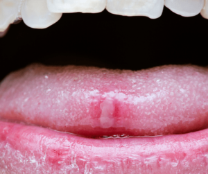 closeup photo of canker sore on tongue