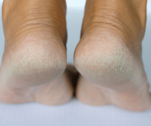 closeup photo of dry skin on feet
