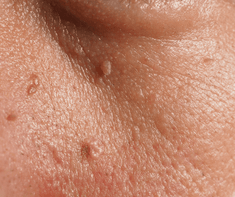 flat warts on face