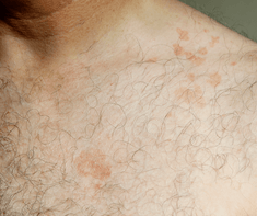 skin with Pityriasis Rosea