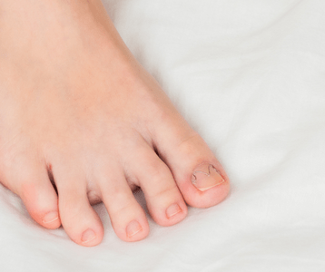 woman feet with ingrown toenail