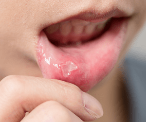 woman with mouth ulcer