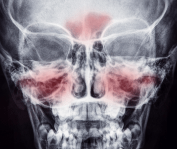 xray of clear sinuses