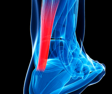 xray photo of tendonitis