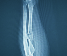 xray showing fractures